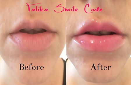 Talika Smile code Lip Plumper Before and after picture