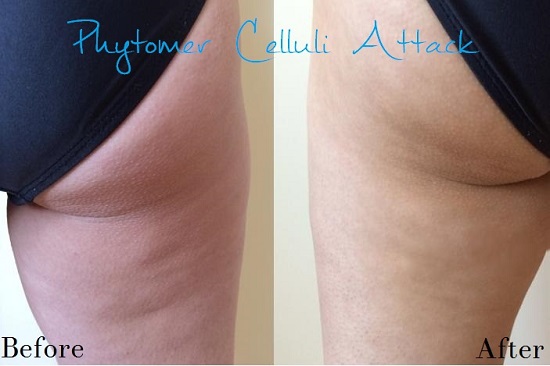 phytomer celluli attack cellulite cream before and after pic